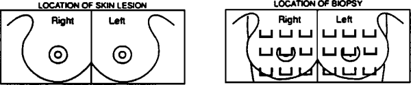 graphic of 2 mammographic views: 1. location of skin lesion 2. location of biopsy