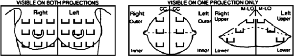 graphic of 2 mammographic views: 1.visible on both projections 2.visible on one projection only